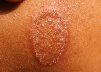 Fungal Groin Infection – Symptoms and Treatment