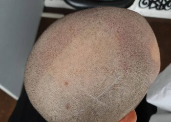 10 Benefits of Scalp Micropigmentation as a Hair Loss Treatment
