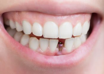 All About Dental Implants in Turkey