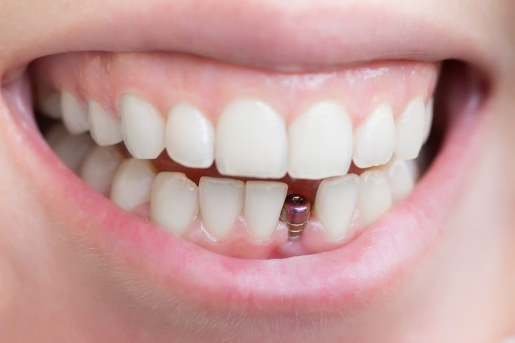All About Dental Implants in Turkey