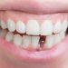 All About Dental Implants in Turkey