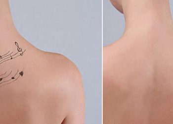 The Basic Laser Tattoo Removal Process
