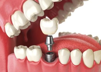 Why Dental Implants In Birmingham Are So Popular
