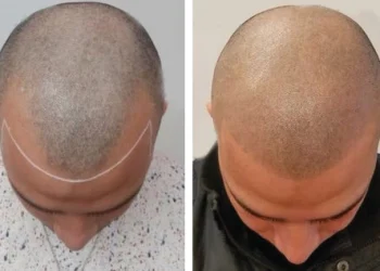 Scalp Micropigmentation: Benefits, Aftercare Tips & More
