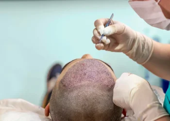 The Life-Changing Benefits of Hair Transplant Surgery
