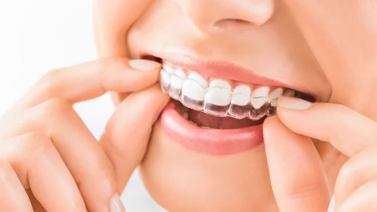 Say Goodbye to Braces Embarrassment: Introducing Invisalign Grays – The Ultimate Solution for Confident Orthodontic Care