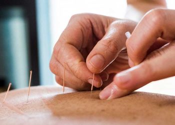 Acupuncture in Chelsea: A Gateway to Holistic Healing
