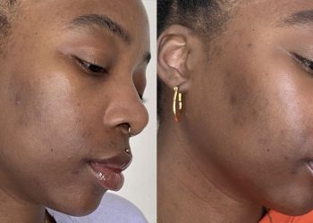 Unleash Your Clearer, Brighter Complexion: How Azelaic Acid 15% Transforms Your Skincare Routine