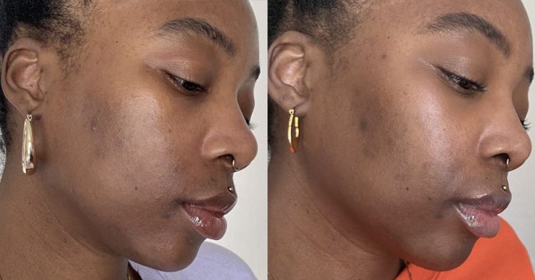 Unleash Your Clearer, Brighter Complexion: How Azelaic Acid 15% Transforms Your Skincare Routine