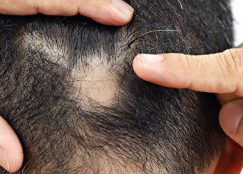 Navigating Treatment Options for Scarring Alopecia