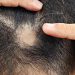 Navigating Treatment Options for Scarring Alopecia