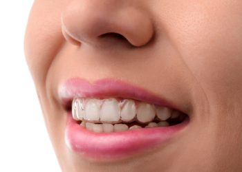 Beyond Braces: How Invisalign is Changing Orthodontics in Raynes Park