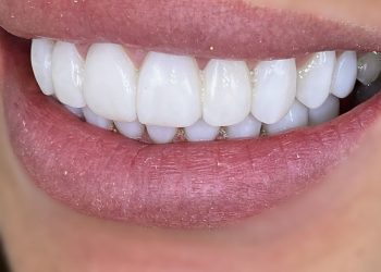 A Confident Smile: Achieving Aesthetic Harmony with Cosmetic Bonding