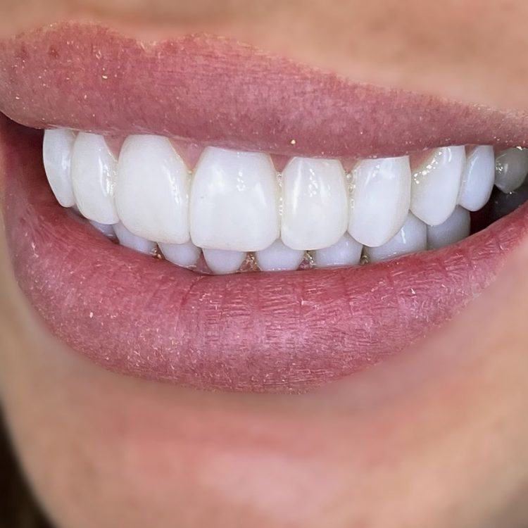 A Confident Smile: Achieving Aesthetic Harmony with Cosmetic Bonding
