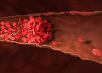 From Risk to Recovery: A Comprehensive Guide to Blood Clot Awareness