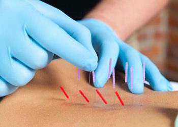 Is Dry Needling Right for You? A Comprehensive Guide