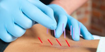 Is Dry Needling Right for You? A Comprehensive Guide