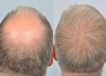 The Power of Hair Transplant Reviews London in Making the Best Choice