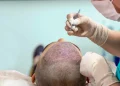 Finding a Trusted Hair Transplant Surgeon in London: A Complete Guide