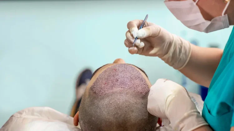 Finding a Trusted Hair Transplant Surgeon in London: A Complete Guide